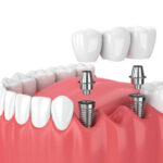 Denture implants